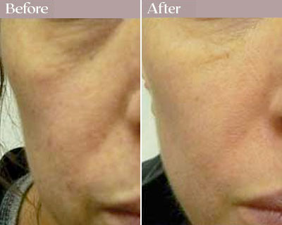 cheek fillers before after nyc